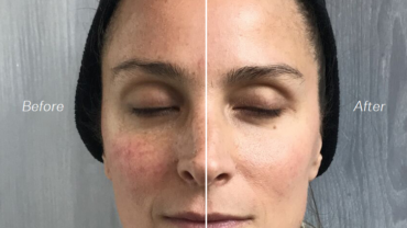 Cryoskin Skin Toning Face - Before and After